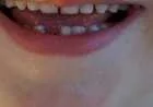 كم عدد الأسنان اللبنية