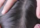 كيف تعالج قمل الشعر