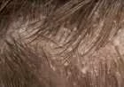 علاج قشرة الشعر