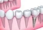 ما هي زراعة الاسنان