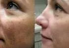 طرق لإزالة آثار الحروق من الوجه