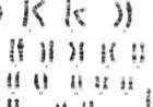 عدد الكروموسومات في متلازمة تيرنر