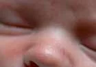 البقع البيضاء على الوجه عند الأطفال