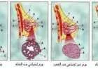 مراحل تطور سرطان الثدي