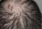 علاج طبيعي لمنع تساقط الشعر