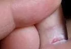 فطريات بين أصابع القدم وعلاجها