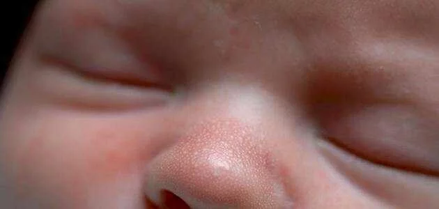 البقع البيضاء على الوجه عند الأطفال