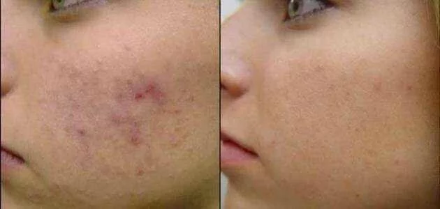 مقال عن كيفية إزالة آثار البثور من الوجه
